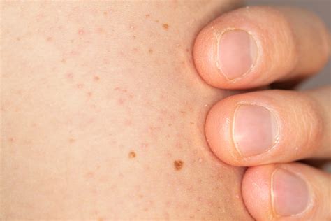 Keratosis Pilaris | VitalSkin Dermatology
