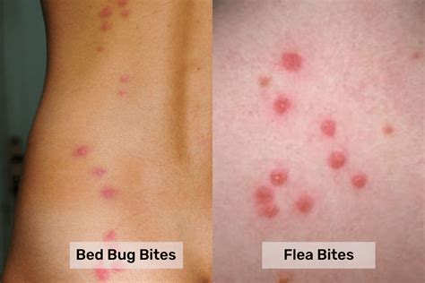 Bed bugs bite vs. Flea Bite: What's the Difference? - Pest Control Gurus