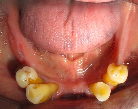 Dental Update - Prosthodontic Rehabilitation of a Patient with an