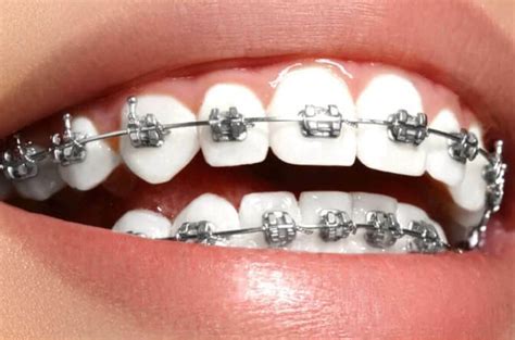 Відкритий прикус ️ Лікування відкритого прикусу | MySmile®