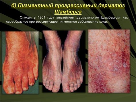 Васкулиты кожи - презентация онлайн