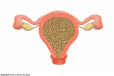 O'que É Gravidez Molar - Mola Hidatiforme (Gravidez Molar): o que é, Tratamento e Mais | Saúde ...