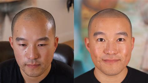 Hairline Tattoos to Thicken Hairlines - Scalp Micro USA