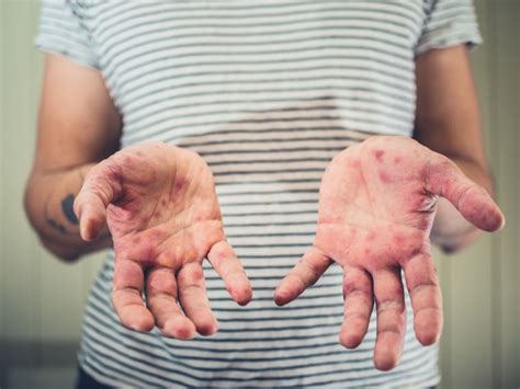 Hand, foot and mouth disease: Symptoms, causes and treatments