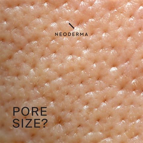 dead skin pore size neoderma
