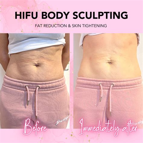 HIFU-Skin Tightening — Bodylicious Aesthetic Clinic