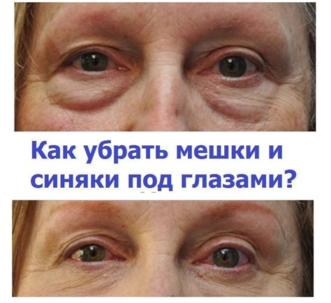 Виды Мешков Под Глазами Фото И Причины – Telegraph