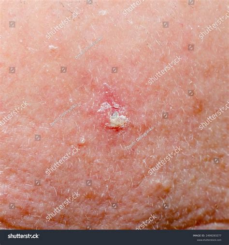 31 Scalp Basal Cell Carcinoma Royalty-Free Images, Stock Photos