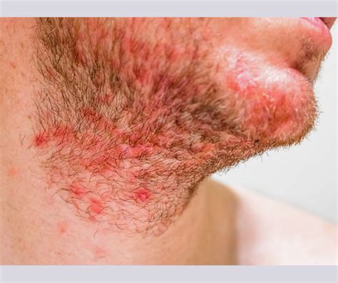 Promotions | Permanent Choice - Permanent Choice Laser Hair Removal ...