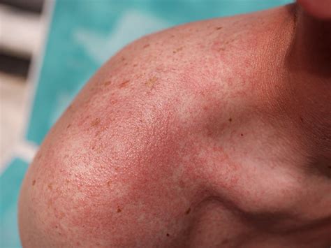 Prickly Heat Rash: Treatments, Causes, and More