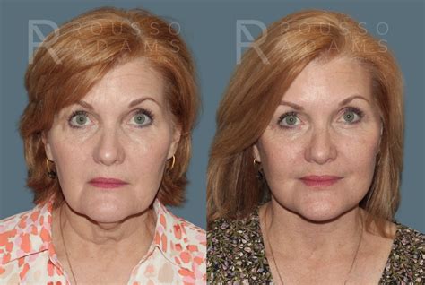 patient  gallery rousso adams facial plastic surgery
