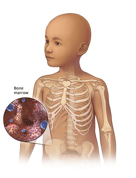 cancer types  cancer st jude  basics  blood
