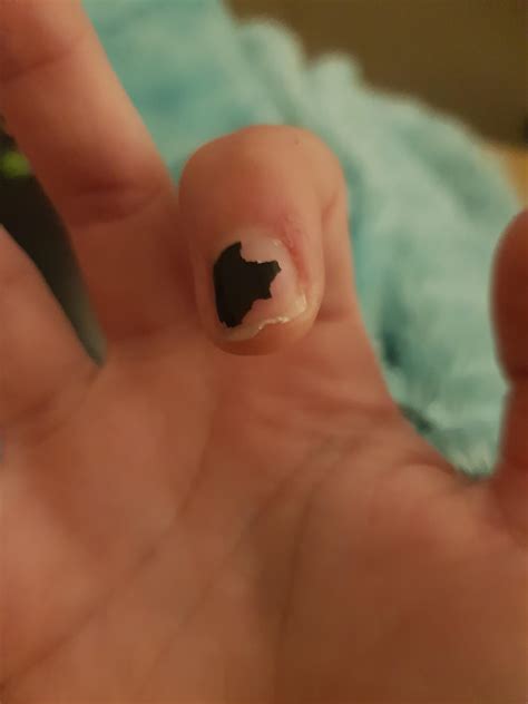 Why Does My Fingernail Have A Dip In It at James Marts blog