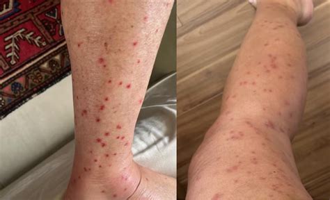 O Que Atrai Borrachudos - Infestação de mosquitos borrachudos atinge nível crítico no Rio de ...