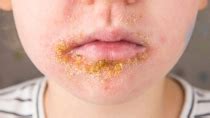 Borkenflechte: Ursachen, Symptome und Behandlung | gesund.bund.de