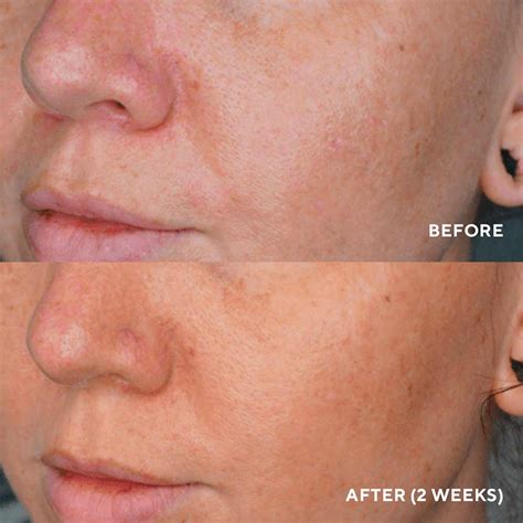 LumaPro-C Face Serum – HydroPeptide Official Site