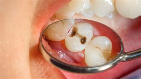 black stains  teeth   treatment  bassendean