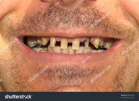 man bad teeth images stock  vectors shutterstock