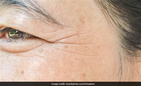 Do You Have A Drooping Eyelid (Ptosis)? Everything You Should Know About It