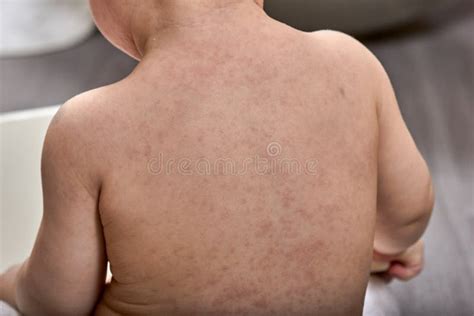 roseola rash  viral rash   skin   child stock photo image