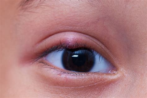The Ultimate Guide To Common Eye Problems Infographic - vrogue.co