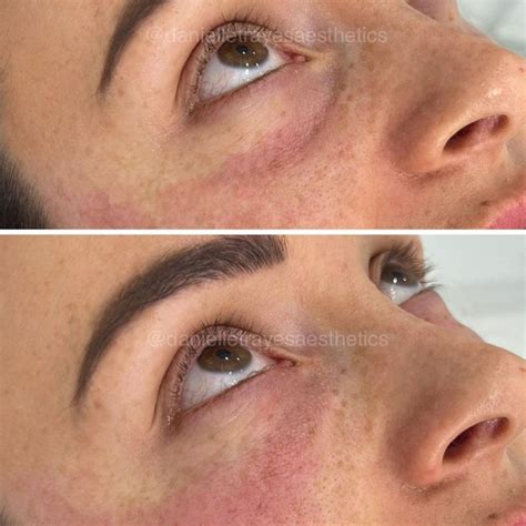 Eye Treatments - Rejuvenate Laser & Skin Clinic