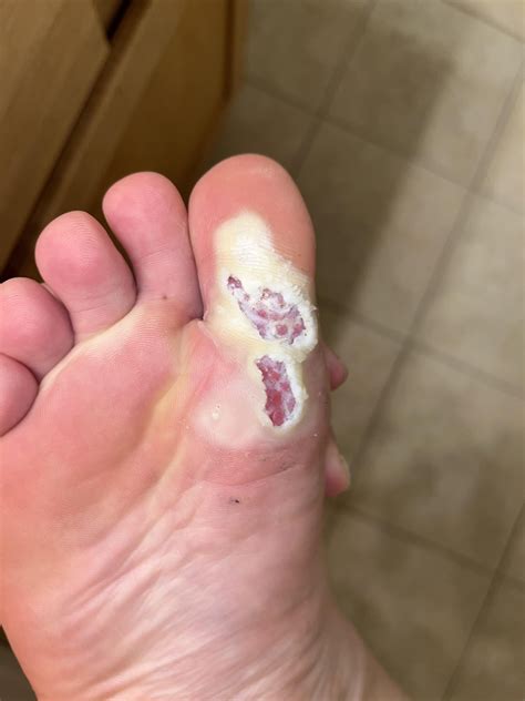 Update: 1 week after freezing plantar wart. Still pretty uncomfortable