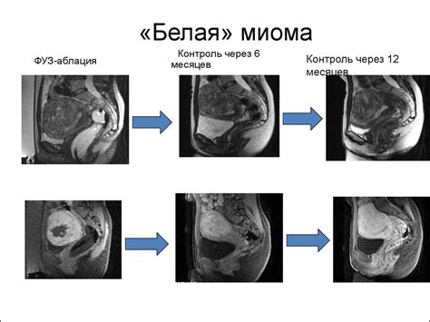 МРТ органов женского малого таза. Доброкачественные образования. Миома ...