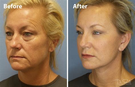 Face & Neck Lift 8 - Dr. Schalit Cosmetic Facial Specialist