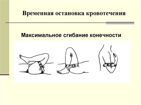 Кровотечение. Методы остановки кровотечения - презентация онлайн