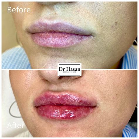 dr hasan benar dr benar signature lips