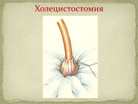 Острый и хронический холецистит. Осложнения острого холецистита ...