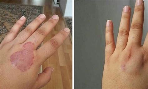 Travazol Krem Ne İşe Yarar ? Travazol Kullanımı ve Fiyatı - Bitkisel ...