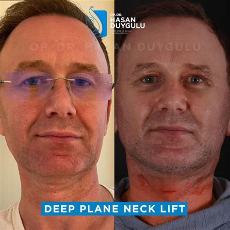 Facelift in Turkey, Istanbul | Dr. Hasan Duygulu