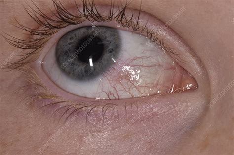 Episcleritis - Stock Image - C047/2966 - Science Photo Library