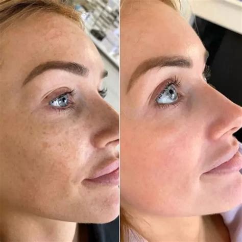 The Best Treatment for Face Pigmentation Removal: Cosmelan - The Brow ...