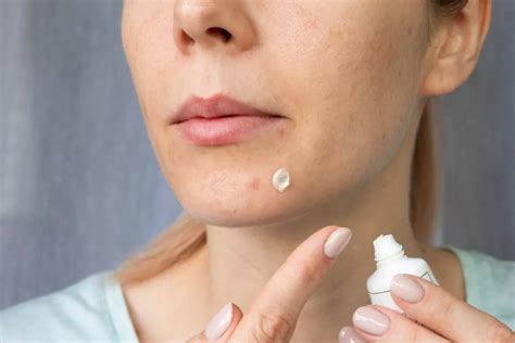 Как избавиться от пятен после прыщей - Beauty HUB