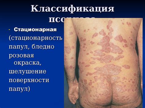 Псориаз - презентация онлайн