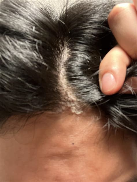Heard it might be scalp psoriasis : r/dandruff