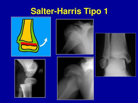 PPT - Fracturas en la Infancia PowerPoint Presentation, free download