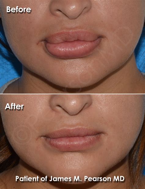 lip reduction    dr james pearson facial