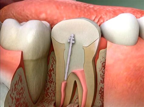 post  core  treatment procedure rehan dental surgery