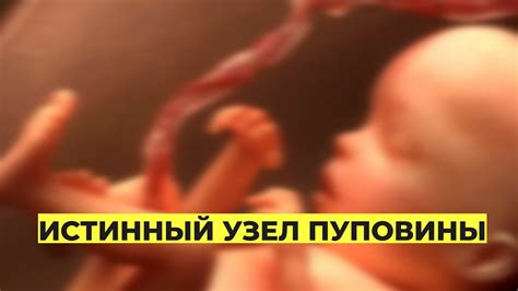 Истинный Узел Пуповины . УЗИ Пуповины Плода - YouTube