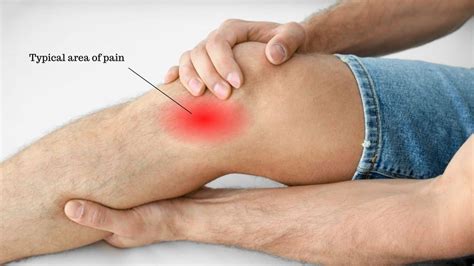 pes anserine bursitis treatment