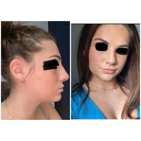 Rhino/Septoplasty - Before / 2 weeks / 3 months / 10 months. Front and