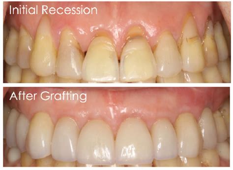 Gingival Graft Before And After