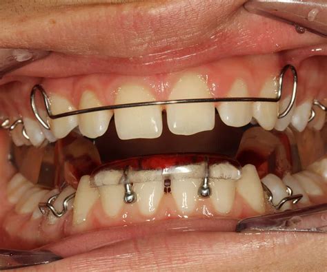 functional appliance inline orthodontics