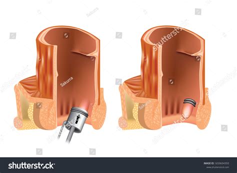 72 Rubber band ligation Images, Stock Photos & Vectors | Shutterstock