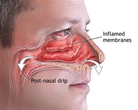 runny nose  diagnosis     rid   runny nose