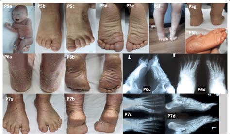 Patients 5-7 with autosomal recessive congenital ichthyosis. Collodion ...